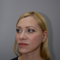 Пластика лица