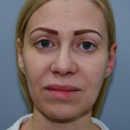 Пластика лица