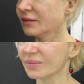 Отзыв о Ultherapy (Альтера-Терапия): Омоложение без операций