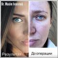 Трансконъюктивальная блефаропластика у хирурга Максима Иванчука